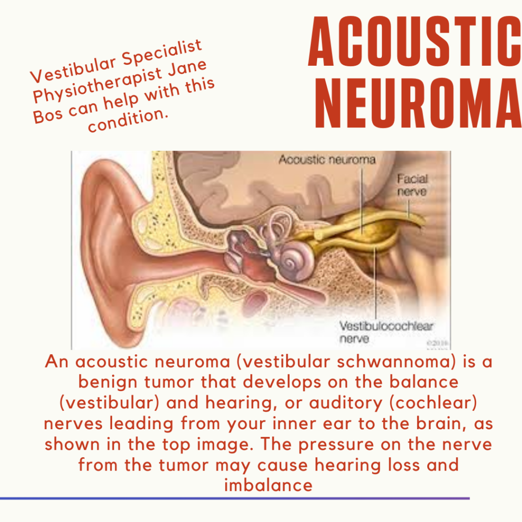 Acoustic Neuroma Bury Physio